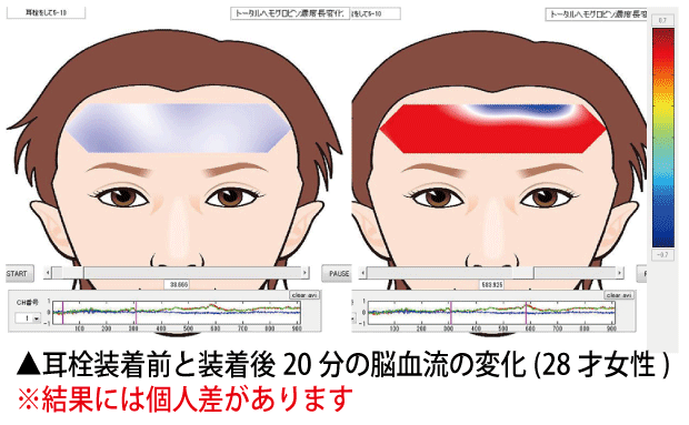 【お取り寄せ★納期 最長 約2週間】電磁波対策シリーズ スッキリ除電耳栓 ミミケア 耳鼻兼用★静電気除去!生体電流を高めて頭も視界も聴力もはっきり